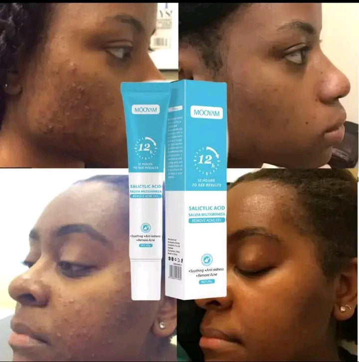 MOOYAM (Gel anti-acnés & boutons)